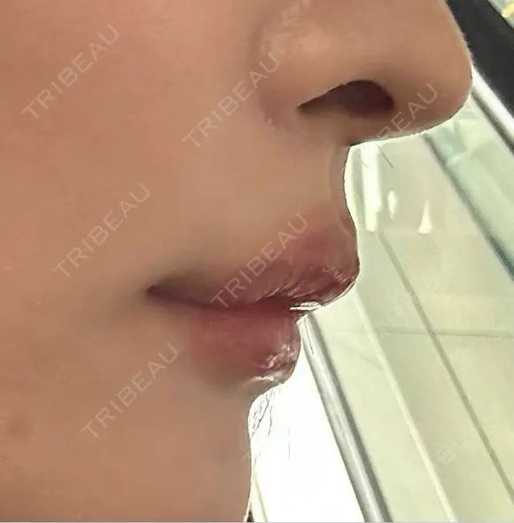 ヒアルロン酸注入（唇） / ボトックス（人中） THE FIRST CLINIC 町田院 AFTER メイン用