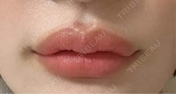 ヒアルロン酸注入（唇） / ボトックス（人中） THE FIRST CLINIC 町田院 DAY 2 メイン用