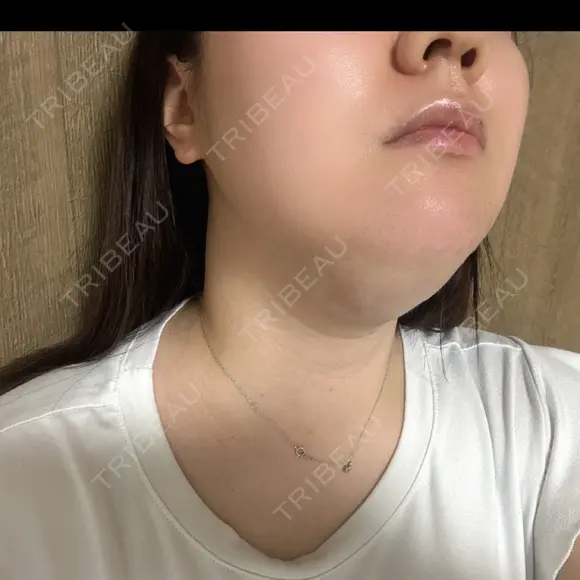 脂肪溶解注射（顔） / ニキビ治療 SUI CLINIC AFTER メイン用