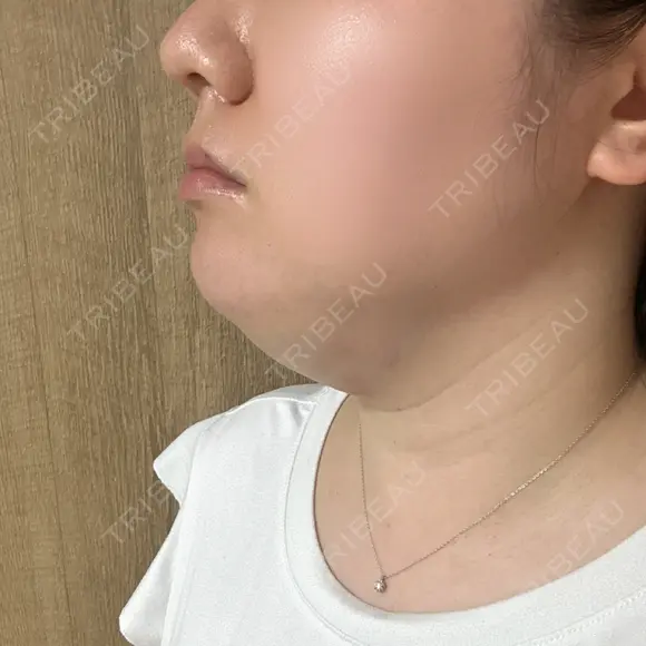 脂肪溶解注射（顔） / ニキビ治療 SUI CLINIC DAY 0 メイン用