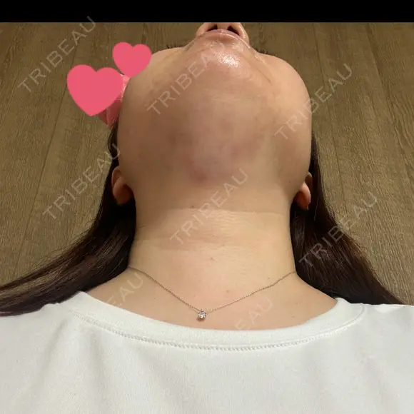 脂肪溶解注射（顔） / ニキビ治療 SUI CLINIC DAY 0 メイン用