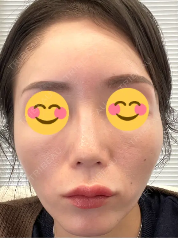 ピコレーザートーニング（美白・肝斑） シェリークリニック 渋谷院 DAY 10 メイン用