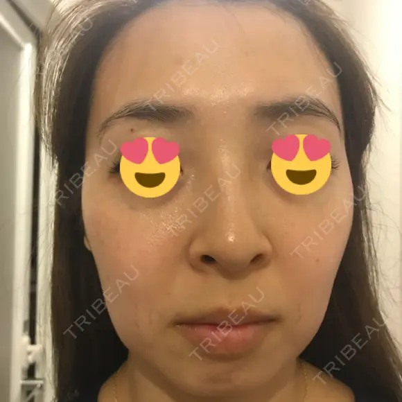 水光注射（ハリ・美肌） / ハイフ（顔） シロアム韓方美容・ダイエットクリニック(美&EYE) DAY 18 メイン用