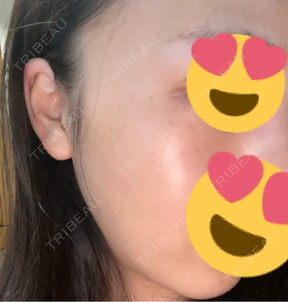 光治療（フォトフェイシャルなど） トラスト美容クリニック 銀座院 AFTER メイン用