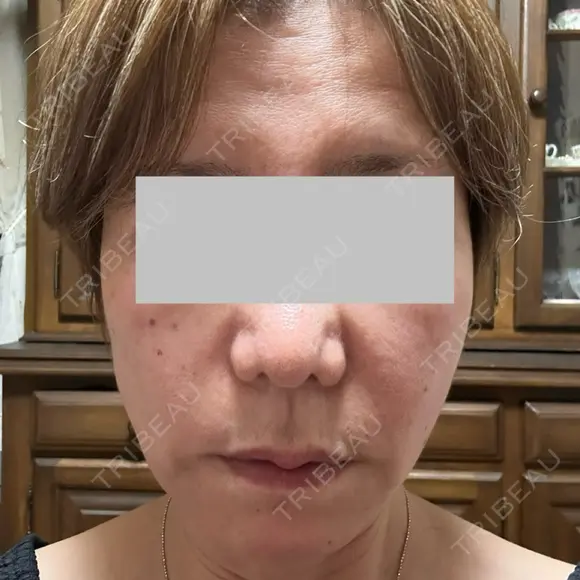 RF（高周波）たるみ治療 Wi Clinic （ウィ クリニック）心斎橋院 AFTER メイン用