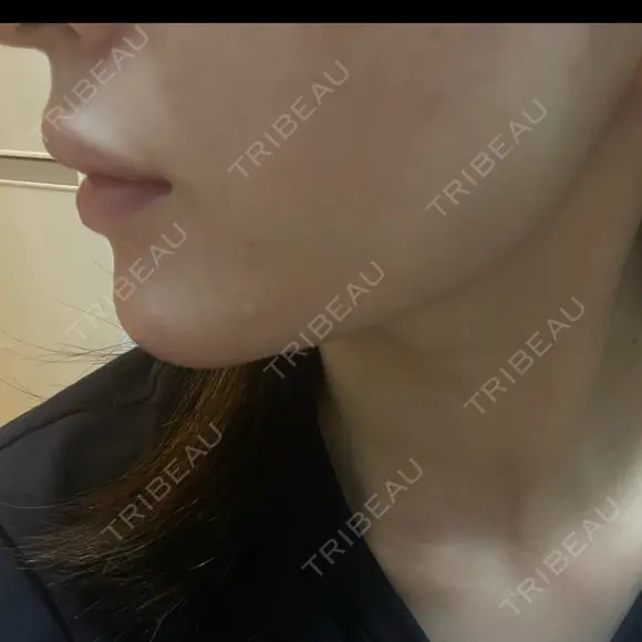 ボトックス（口角） / ボトックス（人中） DMTC CLINIC 日本橋院 DAY 4 メイン用