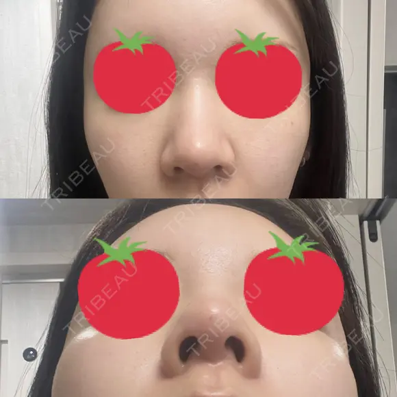 ヒアルロン酸注入（鼻） A CLINIC（エークリニック） 横浜院 DAY 1 メイン用