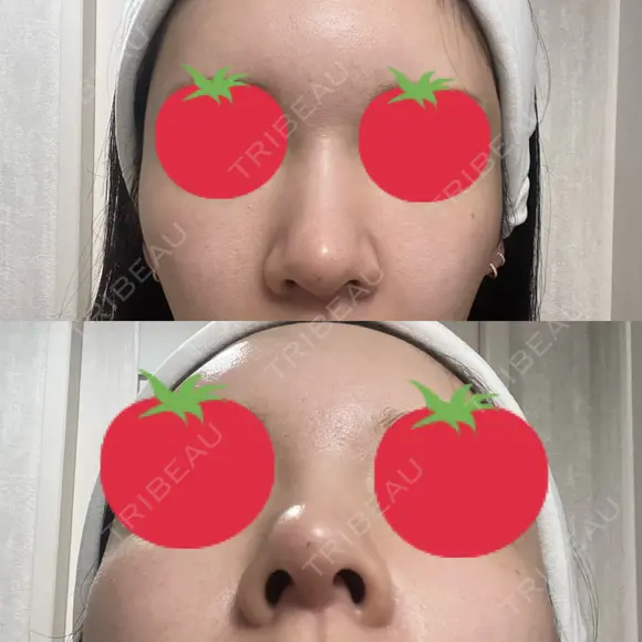 ヒアルロン酸注入（鼻） A CLINIC（エークリニック） 横浜院 DAY 1 メイン用