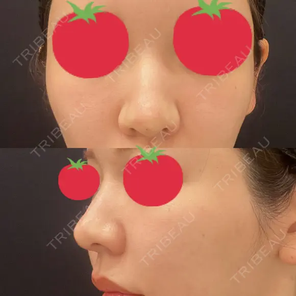 ヒアルロン酸注入（鼻） A CLINIC（エークリニック） 横浜院 DAY 0 メイン用