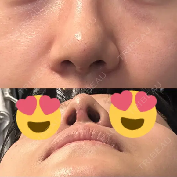 鼻尖形成（切開） / 小鼻縮小（切開） / 軟骨移植 ASTRA BEAUTY CLINIC AFTER メイン用