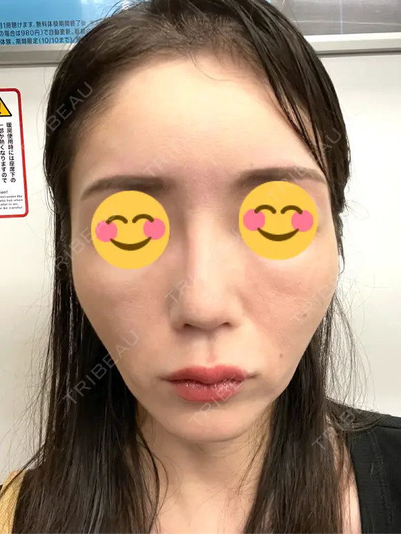 ピコレーザートーニング（美白・肝斑） シェリークリニック 渋谷院 AFTER メイン用