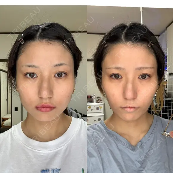 ボトックス（エラ・小顔） / ボトックス（肩） DMTC美容皮膚科 大宮院 DAY 65 メイン用