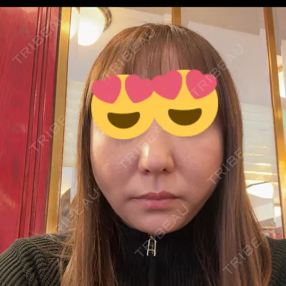 糸リフト BON BON CLINIC 銀座駅前本院 AFTER メイン用