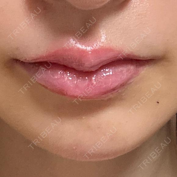 ヒアルロン酸注入（唇） NARU Beauty Clinic 【ナルクリ】 AFTER メイン用