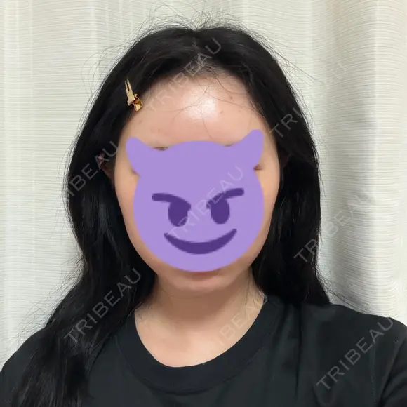 脂肪吸引（顔） / ボトックス（エラ・小顔） WOM CLINIC GINZA （ワム クリニック ギンザ） DAY 21 メイン用