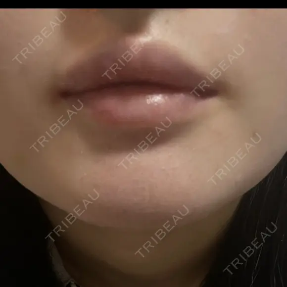 ボトックス（口角） / ボトックス（人中） DMTC CLINIC 日本橋院 DAY 6 メイン用