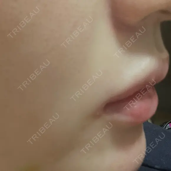 ボトックス（口角） / ボトックス（人中） DMTC CLINIC 日本橋院 AFTER メイン用