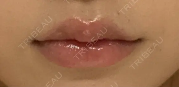 ヒアルロン酸注入（唇） プライベートスキンクリニック 梅田本院 DAY 0 メイン用