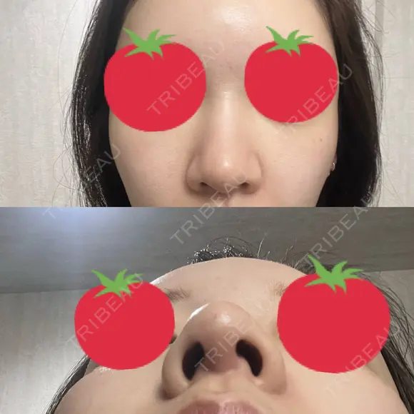 ヒアルロン酸注入（鼻） A CLINIC（エークリニック） 横浜院 DAY 3 メイン用