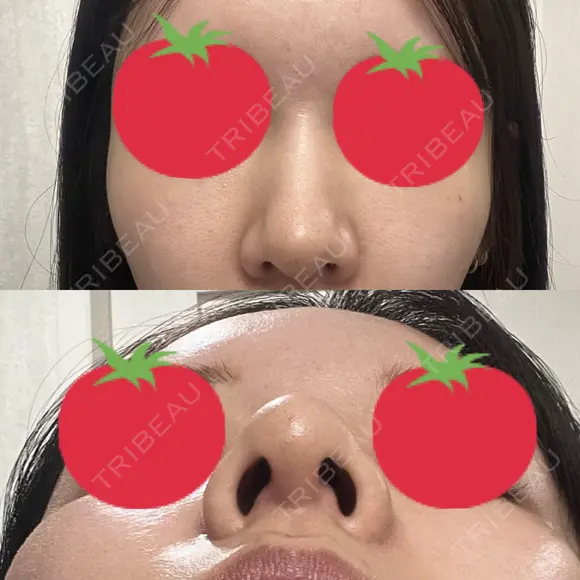 ヒアルロン酸注入（鼻） A CLINIC（エークリニック） 横浜院 DAY 3 メイン用