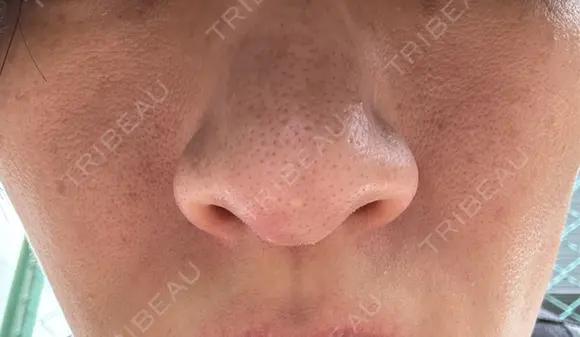 ルメッカ / ミラノリピール ON-CLINIC Beauty AFTER メイン用