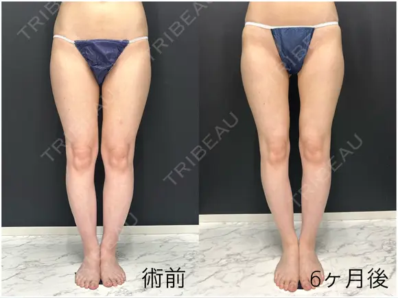 脂肪吸引（脚） 東京脂肪吸引クリニック DAY 204 メイン用