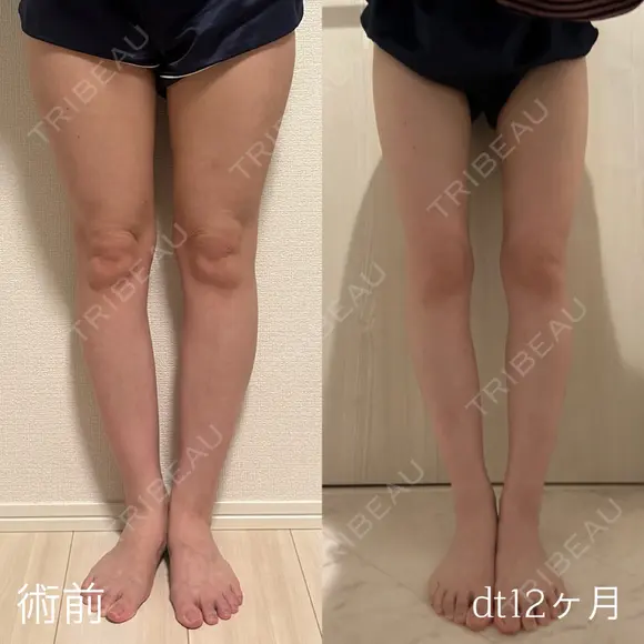 脂肪吸引（脚） 東京脂肪吸引クリニック AFTER メイン用