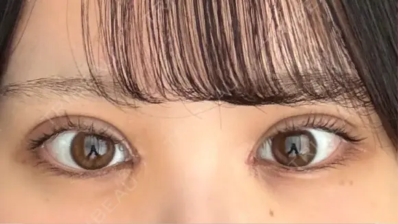 二重埋没 / 目頭切開 東京シンデレラ美容外科 池袋院 DAY 4 メイン用