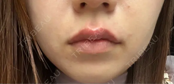 ヒアルロン酸注入（唇） 目白ホワイトクリニック DAY 0 メイン用