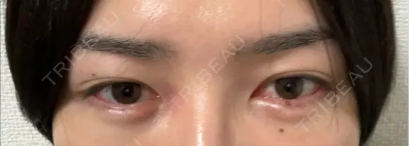 クマ治療 / その他（輪郭） WOM CLINIC GINZA （ワム クリニック ギンザ） DAY 19 メイン用