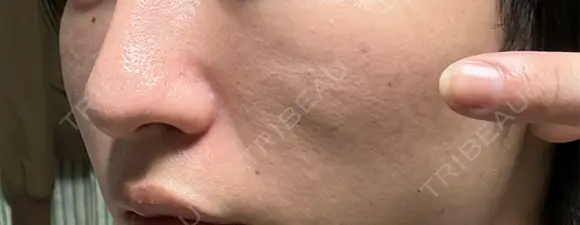 クマ治療 / その他（輪郭） WOM CLINIC GINZA （ワム クリニック ギンザ） DAY 19 メイン用