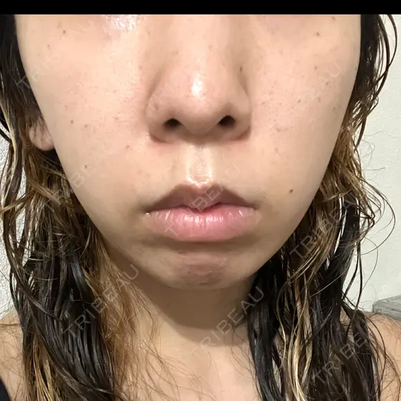 ルメッカ ルラ美容クリニック 岡山院 DAY 0 メイン用