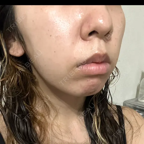 ルメッカ ルラ美容クリニック 岡山院 DAY 0 メイン用