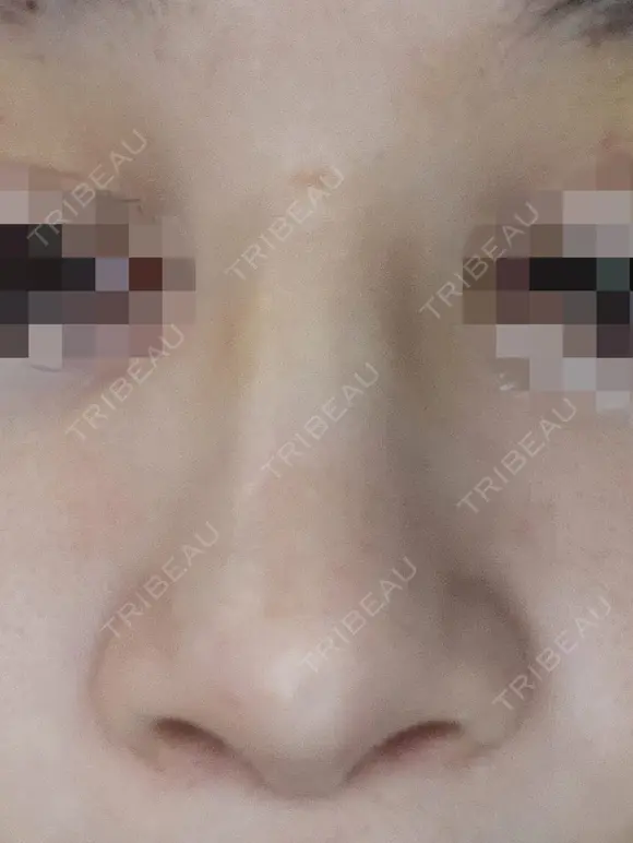 隆鼻術 / 鼻尖形成（切開） / 鼻中隔延長（切開） / その他（輪郭） リッツ美容外科 東京院 AFTER メイン用