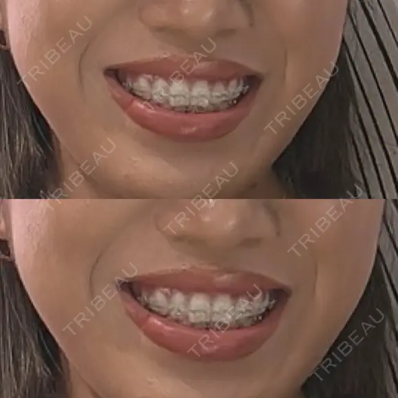 矯正（ワイヤー） Shiny Teeth Clinic 【シャイニー ティース クリニック】 AFTER メイン用