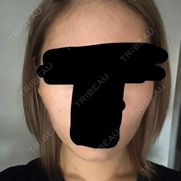 ボトックス（エラ・小顔） 札幌TAクリニック DAY 4 メイン用