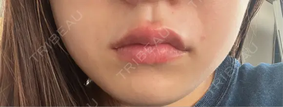 ヒアルロン酸注入（唇） 目白ホワイトクリニック DAY 1 メイン用