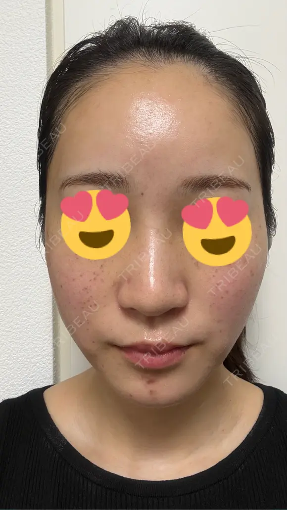 ピコレーザートーニング（美白・肝斑） / ピコフラクショナルレーザー（毛穴・ニキビ跡） / ピコスポット 東京シルククリニック 東京神田院 DAY 1 メイン用