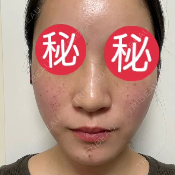 ピコレーザートーニング（美白・肝斑） / ピコフラクショナルレーザー（毛穴・ニキビ跡） / ピコスポット 東京シルククリニック 東京神田院 DAY 2 メイン用