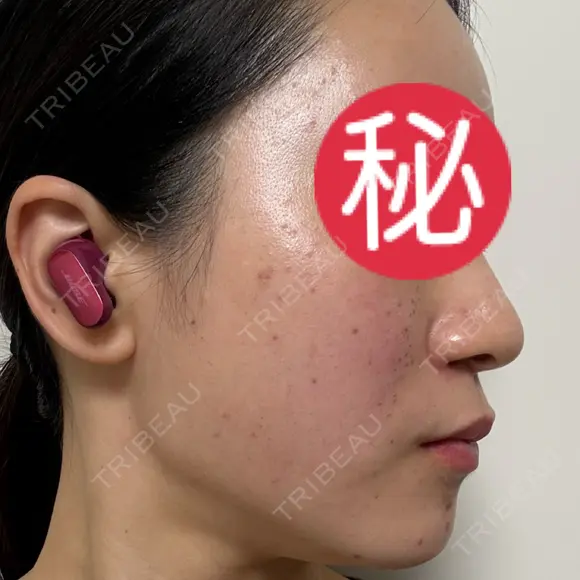 ピコレーザートーニング（美白・肝斑） / ピコフラクショナルレーザー（毛穴・ニキビ跡） / ピコスポット 東京シルククリニック 東京神田院 DAY 2 メイン用