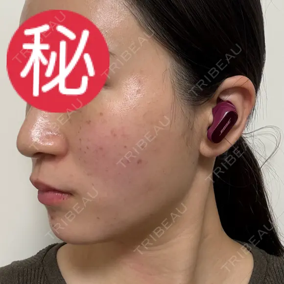 ピコレーザートーニング（美白・肝斑） / ピコフラクショナルレーザー（毛穴・ニキビ跡） / ピコスポット 東京シルククリニック 東京神田院 DAY 2 メイン用