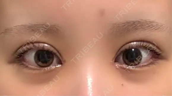 二重埋没 / 目頭切開 東京シンデレラ美容外科 池袋院 DAY 6 メイン用