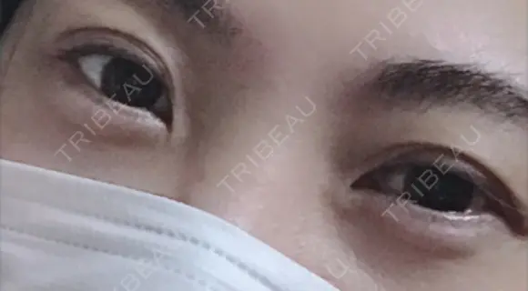 ヒアルロン酸注入（涙袋） 湘南美容クリニック 松山院 AFTER メイン用