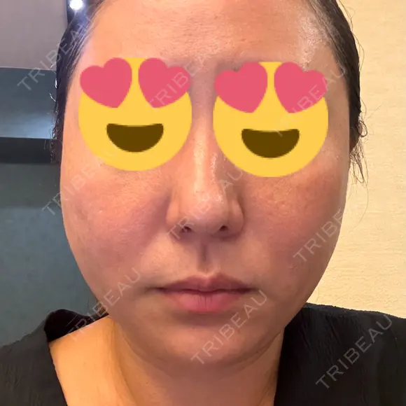 糸リフト BON BON CLINIC 銀座駅前本院 DAY 1 メイン用