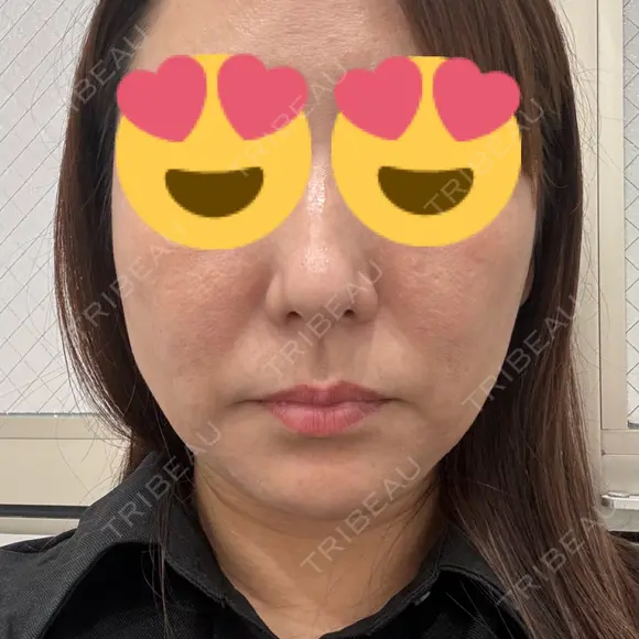 糸リフト BON BON CLINIC 銀座駅前本院 DAY 4 メイン用