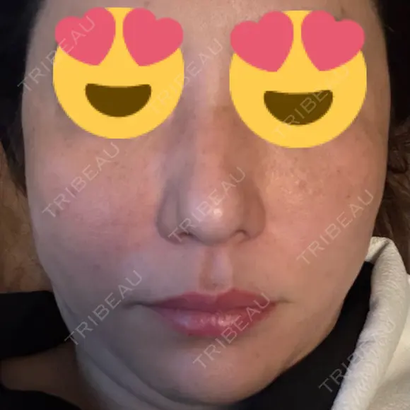 糸リフト BON BON CLINIC 銀座駅前本院 DAY 2 メイン用