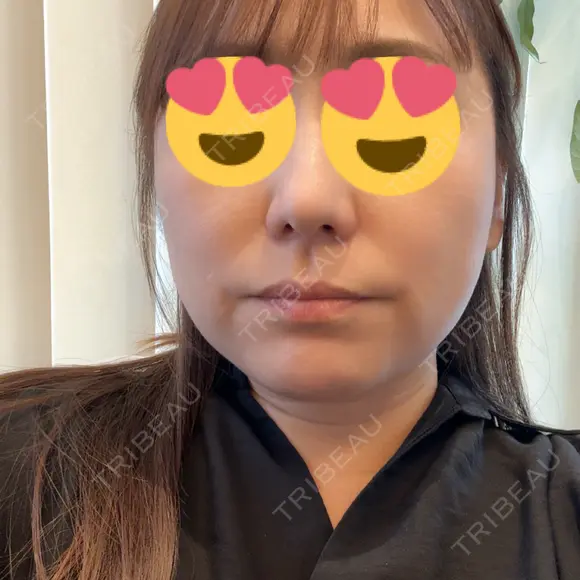 糸リフト BON BON CLINIC 銀座駅前本院 DAY 10 メイン用