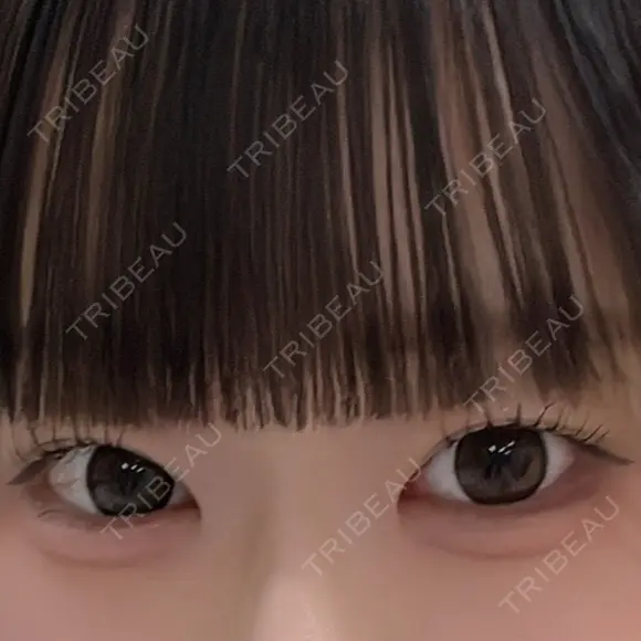 ヒアルロン酸注入（涙袋） / その他（輪郭） ルラ美容クリニック 岐阜院 AFTER メイン用