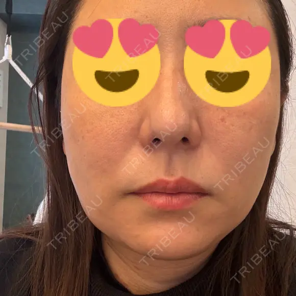 糸リフト BON BON CLINIC 銀座駅前本院 DAY 6 メイン用