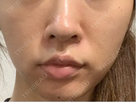 ヒアルロン酸注入（頬） eクリニック 金沢本院 AFTER メイン用